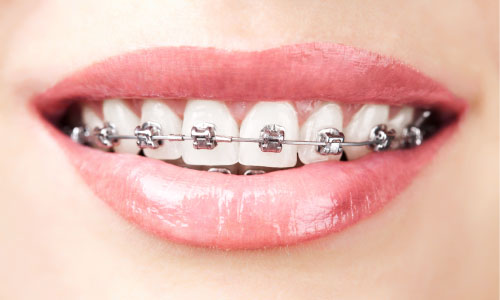 traditional metal nraces