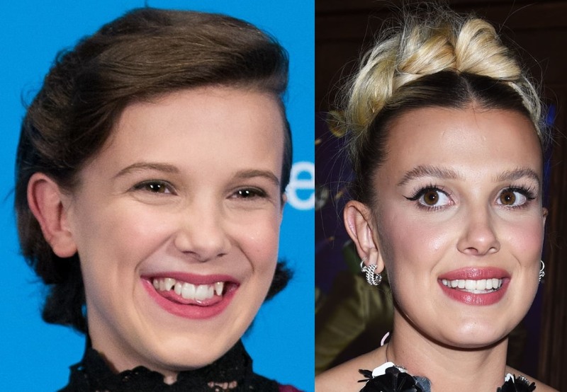 millie bobby browns dental implants before and after