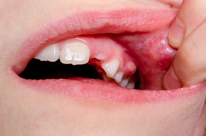 mouth abscess symptoms causes types treatment