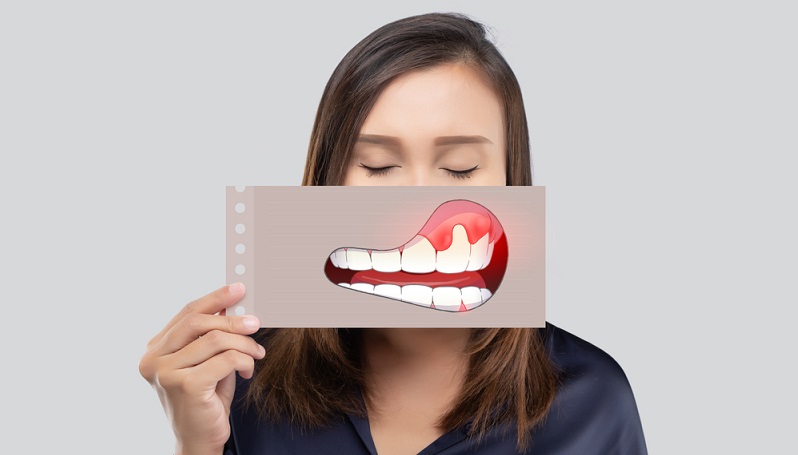 Mouth Ulcers HIV: Are Mouth Ulcers Early Symptoms of HIV?