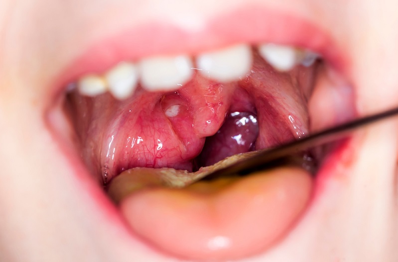 mouth oral infections symptoms causes diagnosis and treatments