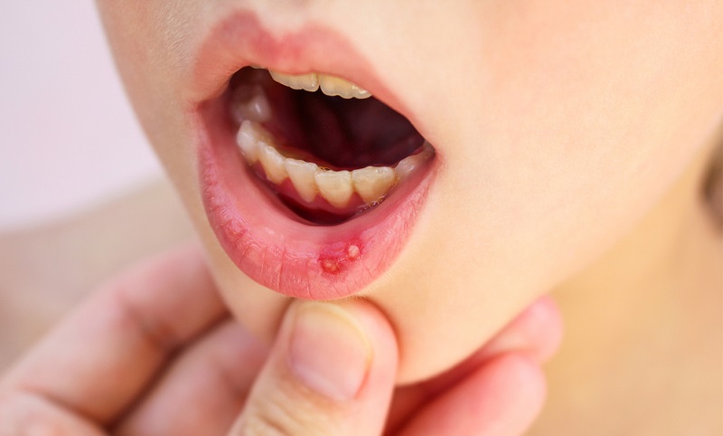 Home Remedies to Cure Mouth Ulcers Naturally Fast