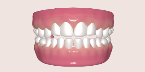 open bite teeth