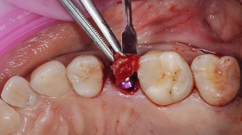Osseointegration of Dental Implants: Stages, Factors, and Their Effects
