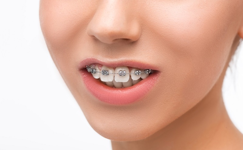 Overbite Before and After Braces: Transformative Results!