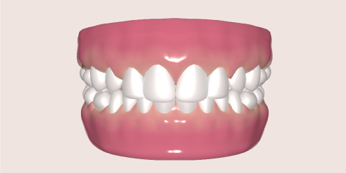 overbite teeth