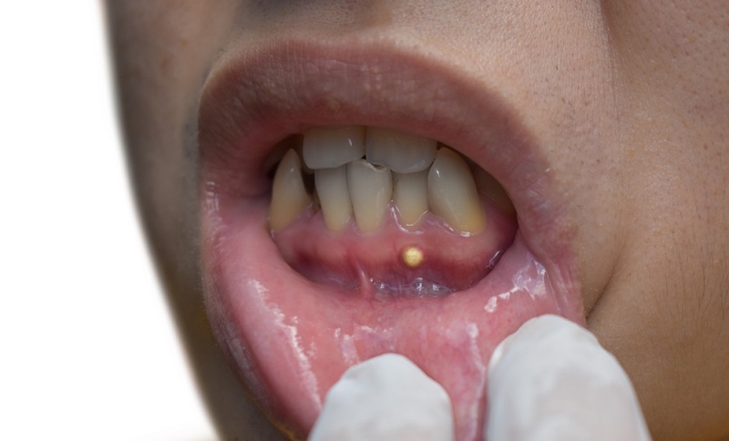 Periapical Abscess: Causes, Symptoms & Best Treatment Options