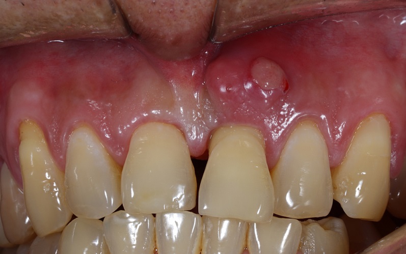 periodontal abscess signs causes treatment and comparisons