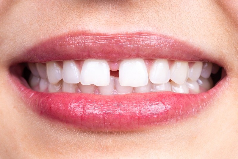 How to Fill the Gaps Between Teeth Naturally at Home?