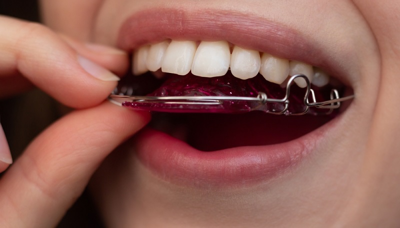 Retainer After Braces: Your Complete Guide to Wearing Retainers