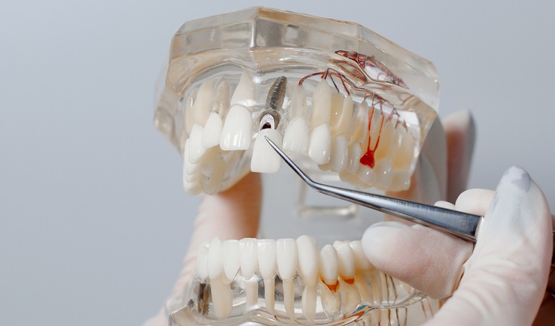 Root Canal Cap: What is It, Types, Cost and Post Treatment Care
