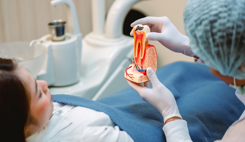 root canal procedure step by step