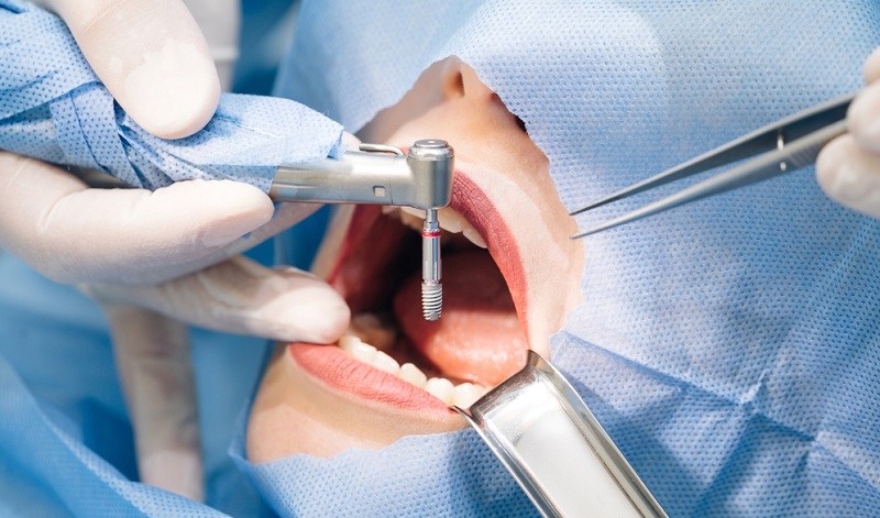 Root Canal vs Implant: Which one is Safer Treatment?