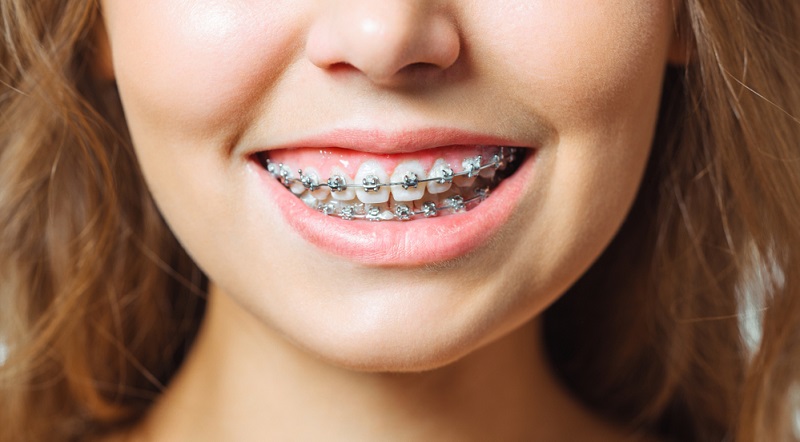 Self-Ligating Braces: Benefits, Costs & Comparison to Traditional Braces