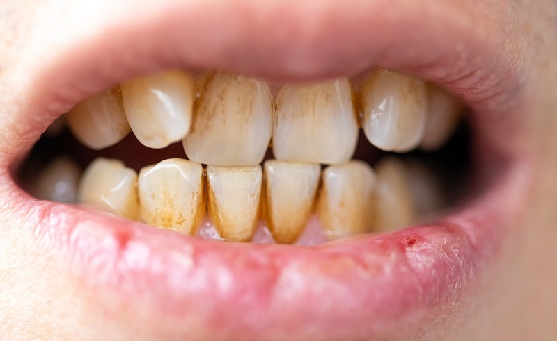 Tartar Buildup: Causes, Prevention & What You Need to Know