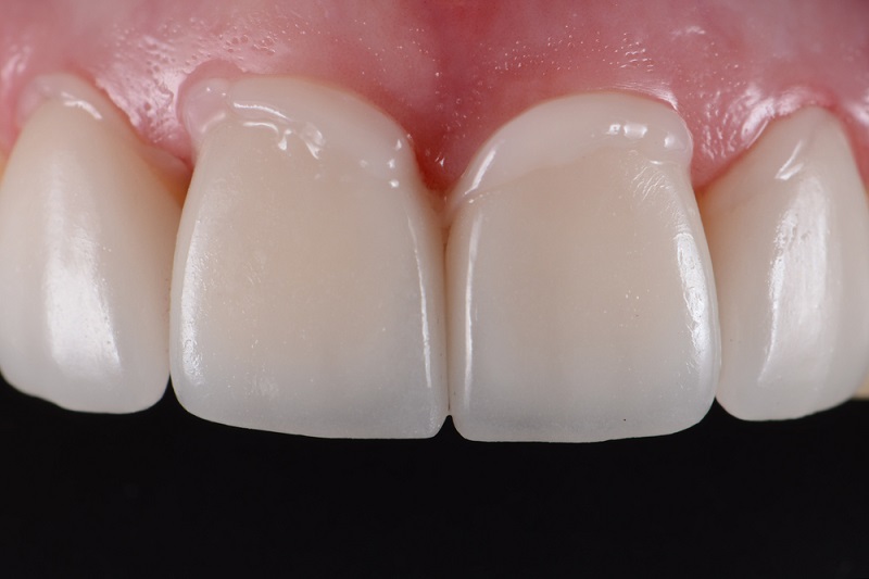 Teeth Bonding vs Veneers: Factors to Consider Before Choosing One