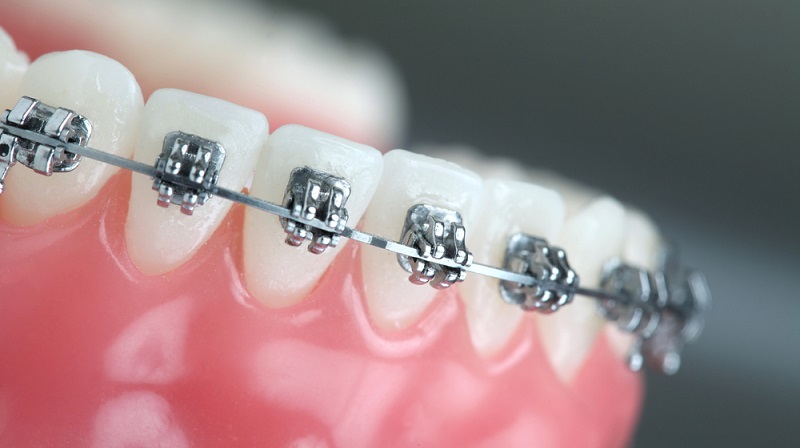 Dezy teeth braces