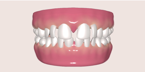 teeth gap