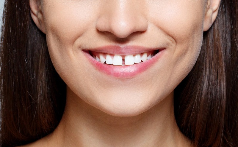 Effective Ways to Fix the Gap in Your Front Teeth