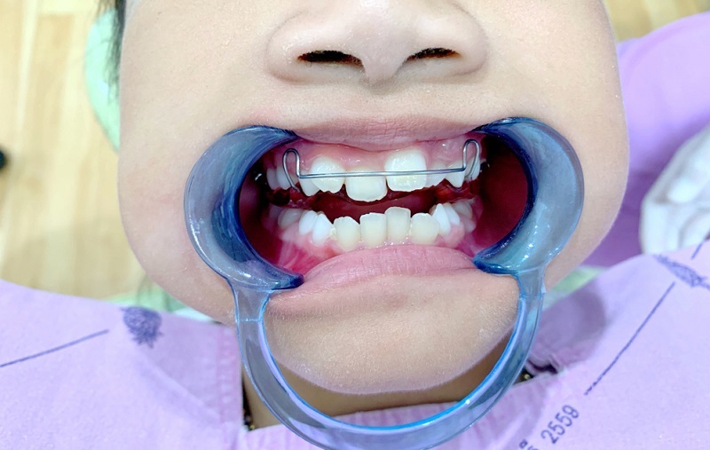 Boosting Your Career Confidence: Managing Teeth Misalignment in the Workplace