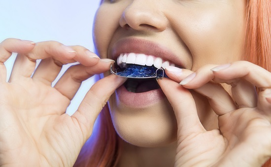 teeth retainers
