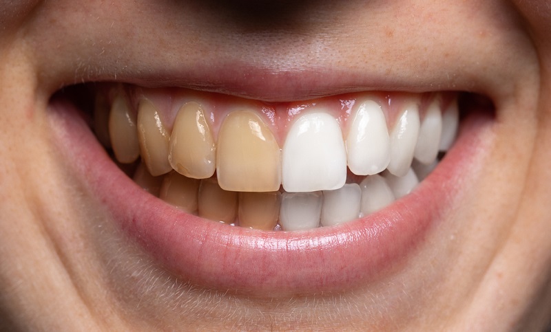 Stains on Teeth: Causes, Treatment and Prevention