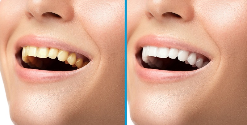 teeth whitening side effects