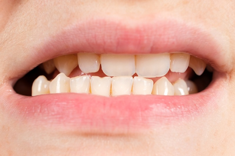 how is tmj disorder jaw different from normal jaw