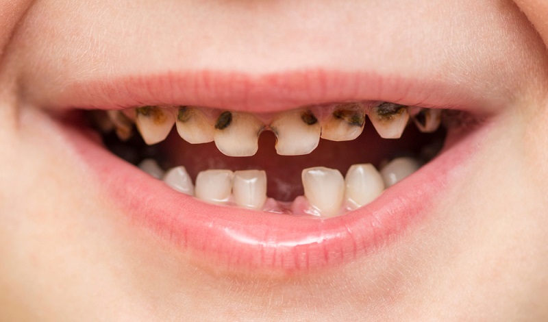 tooth cavities in kids children