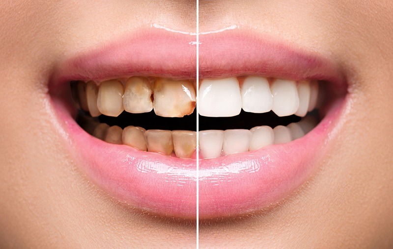 What is the Difference Between a Cavity and a Stain?