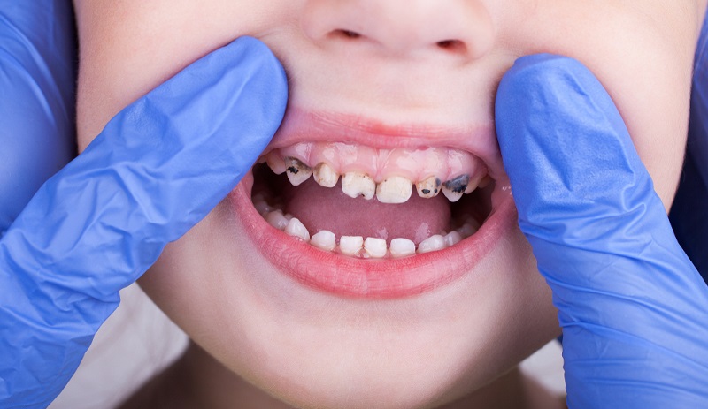 Preventing Tooth Decay in Kids: Essential Tips for Parents