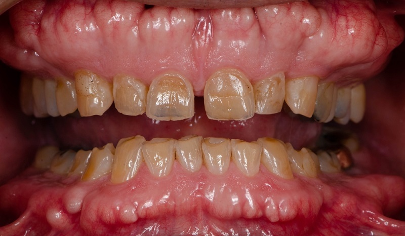 tooth enamel erosion symptoms causes and treatment