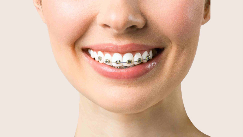 Types of Dental Braces Options Available for Smile Correction