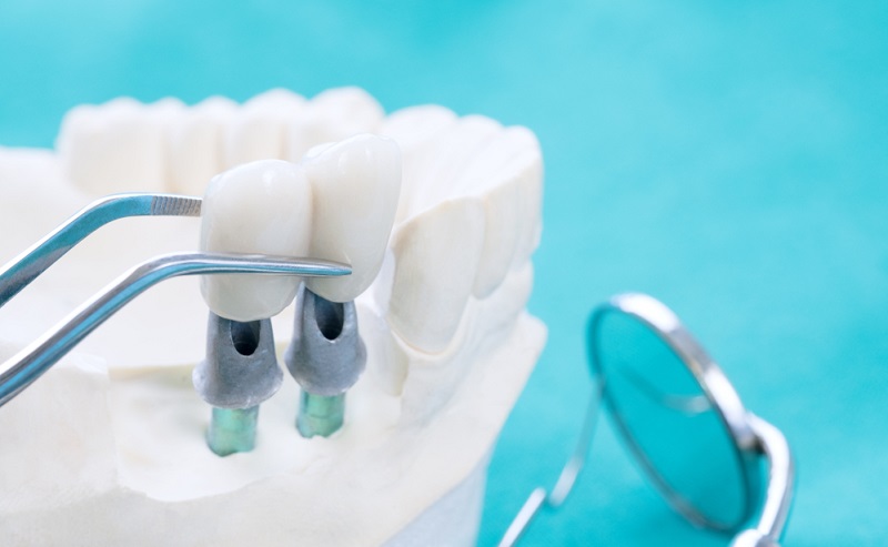 Types of Dental Implants: Which One Is Right for You?