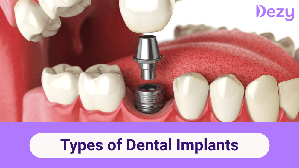 Types of Dental Implants: Which One is Right for You?