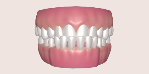 underbite teeth