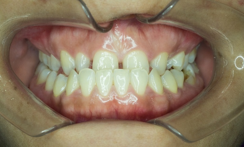 underbite cause treatment