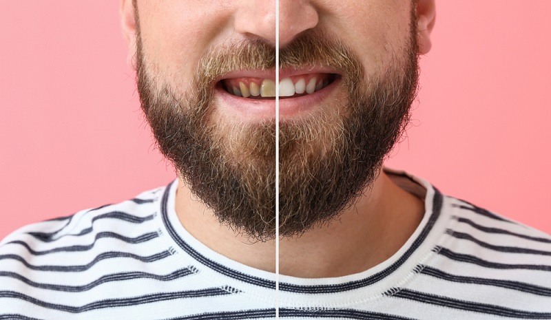 Veneers Before and After Transformation Results with Images