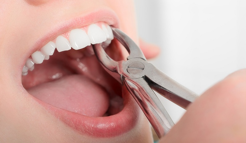 How Much Does Wisdom Teeth Removal Cost in India?