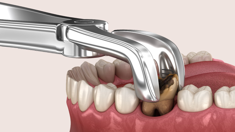 Wisdom Tooth Extraction: Everything You Need to Know