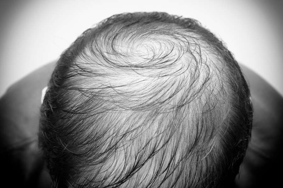 Hair-Care Shouldn&#8217;t Break The Bank &#8211; Transplant Surgery Should Be Accessible and Affordable For All Men