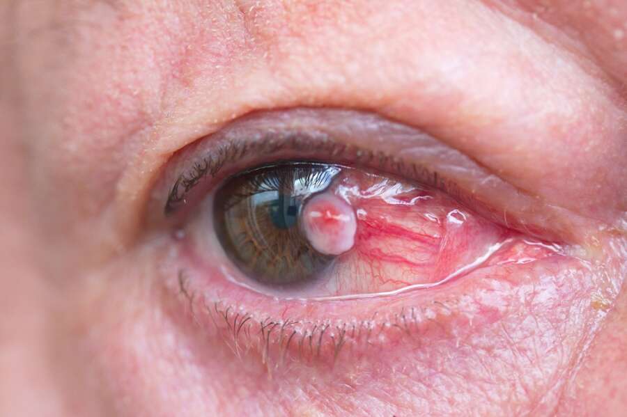 Experts explain how to spot the signs of eye cancer this World Cancer Day