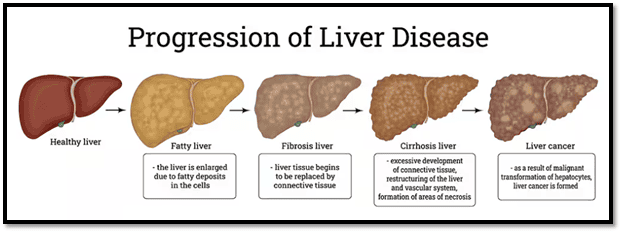 Fatty Liver Without the Booze: Understanding NAFLD, the Modern Metabolic Liver Disease